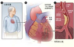 冠心病的起因是什么？