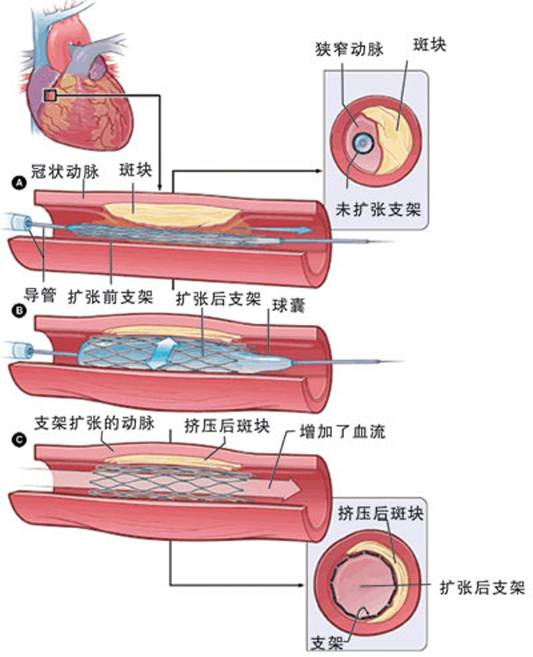 怎樣治療冠心病？(圖2)